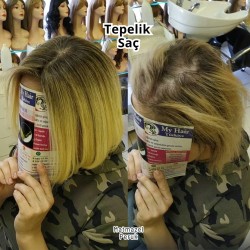 Tepe Kısmındaki Seyrek Saçlar İçin Tül Tepelik İpek Taban Tepelik 