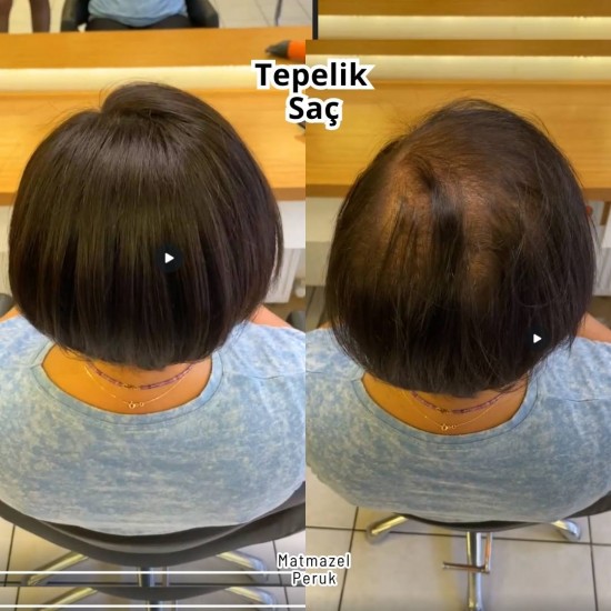İpek Taban Alt Yapısıyla Seyrekliği Kapatan Harika Tül Tepelik Saç